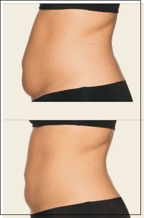 Abdomen and Flanks Before And After Coolsculpting® Elite