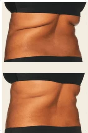 Bra Area and Flanks Before And After Coolsculpting® Elite