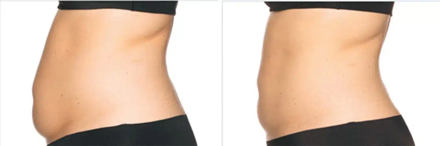 Coolsculpting® Elite Before And After Photo