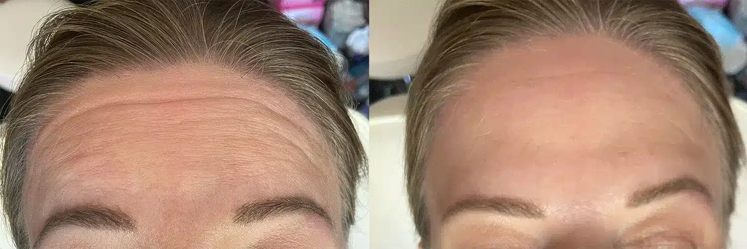Botox® And Dysport® Before And After Photo