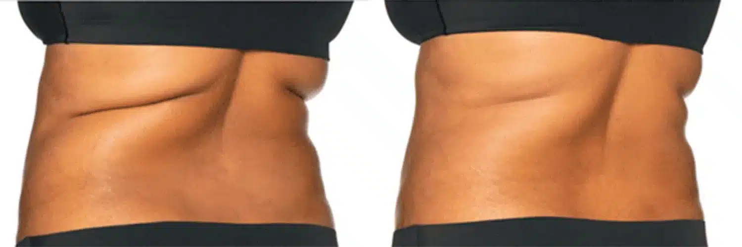 Coolsculpting® Elite Before And After Photo