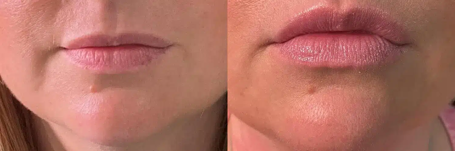 Dermal Fillers Before And After Photo