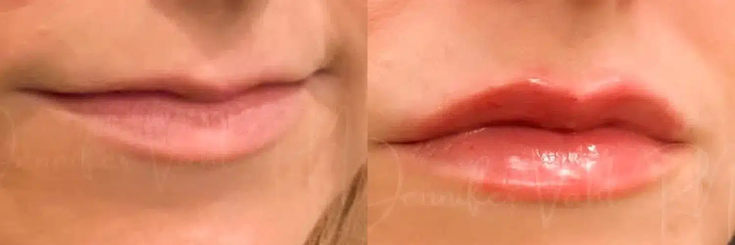 Dermal Fillers Before And After Photo